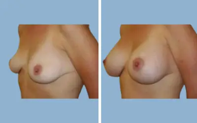 Before and After